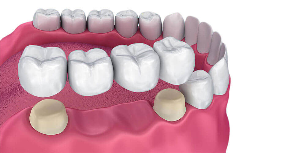 Dental Bridges La Crete