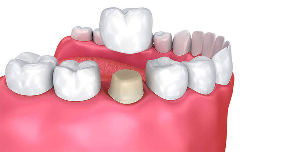 Dental Crowns La Crete