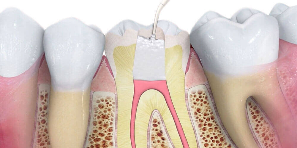 Root Canal Treatment in La Crete