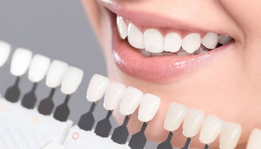 5 Facts About Porcelain Veneers