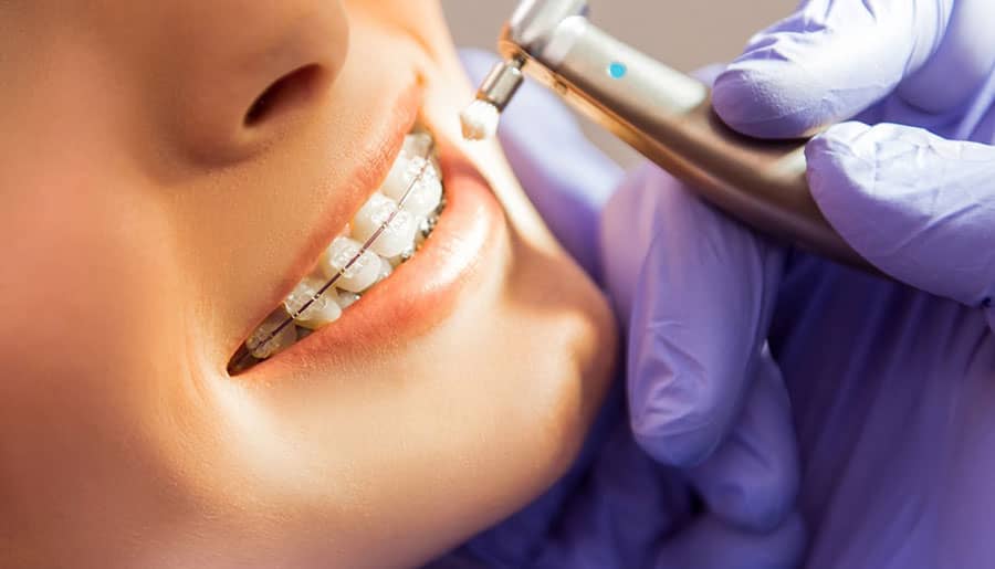 The Benefits of Clear Braces in La Crete