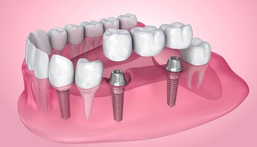 Everything You Need to Know About Dental Implants