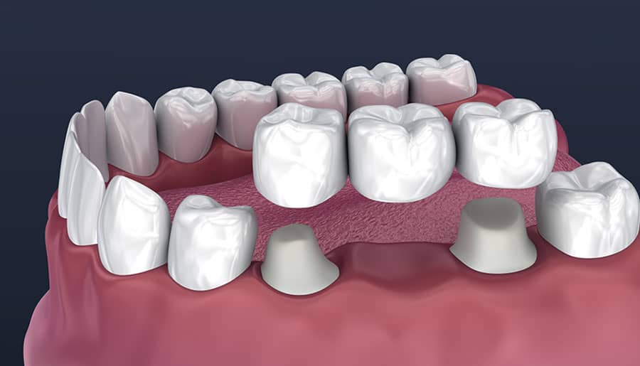 What Are the Roles of Crowns and Bridges?